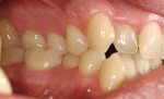 Figure 12  This mirror image of the patient’s left side shows the crossbite and collapse of the arch form.