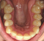 Figure 18  In this image, the maxillary arch was expanding; the teeth looked less crowded and the arch form was beginning to reappear.