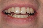 Figure 20  The smile image shows less crowding in the anterior segments along with widened buccal corridors.