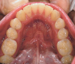 Figure 22  The mandibular arch form at its final stage of Invisalign treatment. Note the beautiful arch form, no crowding, and no crossbite.