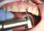 Figure 9  Restorations after the first polishing step with the Q-Finisher®.