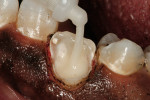 Figure 3  Breeze Cement was injected into the post space using an auto-mix/intraoral tip.