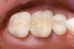 Figure 1  View of the preoperative condition in which PFM and alumina-supported ceramic crowns were cemented using conventional cementation methods.