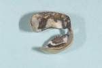 Figure 4  The PFM restoration was removed from the patient’s mouth; visible areas of leakage were evident.