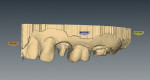 Figure 5  A buccal view of the prepared teeth was scanned into the E4D CAD/CAM system for the lithium-disilicate crown design and fabrication process.
