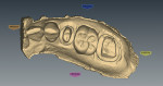 Figure 6  An occlusal view of the prepared teeth, with margins identified for crown design.
