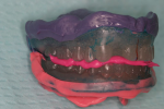 Fig 2. The duplicate denture technique with a wash impression captures soft tissue anatomy while providing an excellent reference for setting teeth conventionally or digitally.
