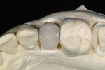 Figure 9  The milled units were seated on the model and ready for occlusal and lingual surface staining.