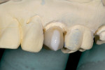 Figure 10  The porcelain layering process on the facial surface developmental lobes was completed to match a natural bleached dentition.