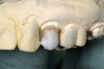 Figure 11  Ivoclar Effect porcelains 1 and 3, and Incisal 1, finished the facial bleached character.