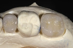 Figure 12  View of the completed monophasic restorations on the occlusal and lingual surfaces.