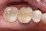 Figure 13  The completed restorations, cemented with Multilink® dual-cure self-etching cement; note the difference in biomimetic appearance between the PFM restoration and the restorations.