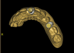 Fig 2. The occlusal view of the STL file with digitally placed teeth and implants. The implant position can be evaluated relative to restorative positions of future restorations.