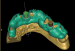 Fig 5. A 3D rendering of the proposed surgical guide. Note the “windows” or “slots” in the guide. These are used by the clinical team to conform a proper seat intraoperatively.
