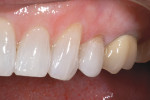 Figure 14  A facial view of the completed lithium-disilicate bicuspid restoration with facial porcelain layering; note the biomimetic integration into the natural bleached dentition.