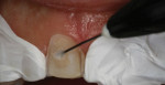 Fig 4. Veneer preparation applying tooth primer. (Panavia™ V5, Kuraray)