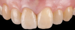 Fig 4. Postoperative situation of single-tooth PFZ crown (Cusp Dental Laboratory, Malden, Massachusetts).