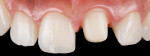 Fig 7. Intraoral situation after crown preparation of tooth No. 9