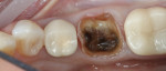 Fig 4. Prepared, dark stump before immediate dentin sealing and buildup.