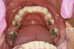 Crowded lower incisors.