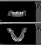 Teeth designated for manipulation in planning software.