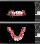 Selectively rotating teeth into proper alignment.