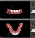 Teeth after alignment in planning software.
