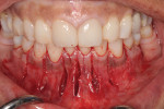 Vertical cuts in soft tissue between teeth.