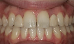 Retracted frontal view depicting the diastema between the two central incisors that exposes the metal framework of the bridge.
