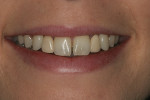 Patient presents with a 6-unit porcelain-fused to-metal Maryland bridge, replacing both the left and right lateral incisors.
