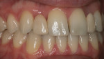 Right lateral view depicting the opaqueness of the Maryland bridge pontic and the greying
effect of the metal retainer present at the lingual aspect of the central incisor.