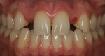 Removal of the restoration immediately eliminates the greying effect from the metal retainers.