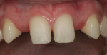 Frontal view of the prepared abutment teeth.