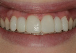 Provisional restorations were placed using a spot etching and spot bonding retention technique.