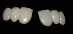 Facial and lingual views of the final restorations.