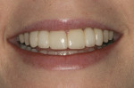 Final treatment photograph taken 2 weeks after insertion during appointment for occlusal
appliance delivery.