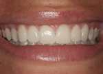 Figure 3  The postoperative smile shows a decrease in the amount of gingival display, a slight filling of the buccal corridor, and a more symmetrical smile.