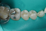 Close-up, preoperative view of a defective occlusal amalgam restoration and recurrent
decay at the margins of tooth No. 19.