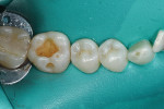 View of the preparation following removal of the
defective amalgam restoration and all recurrent decay, cleaning, rinsing, and light air-drying.