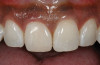 Figure 14  This patient exhibits ankylosed teeth Nos. 8, 9, and 10, but excellent bone.