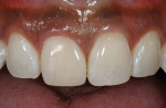 Figure  2  A composite resin veneer was sculpted on the right central incisor to match the color, contour, and shape of the left central. No tooth preparation was needed.