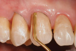 Figure  6  CLINICAL EXAMPLES  A dental adhesive was placed, then a root-colored nano-hybrid composite resin was sculpted.