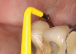 Fig 3. Case 1, 9 mm pocketing with BOP, palatal of upper right first molar.