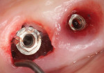 Fig 6. Inflamed collar of tissue was removed, and implant platform and threads and screw opening were accessible for decontamination. Threads are being cleaned with a titanium curette.