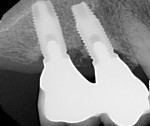 Fig 8. Radiographic evidence of bone fill 28 months post treatment.