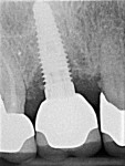 Fig 10. Pre-treatment radiograph showed mesial and distal vertical bone loss.