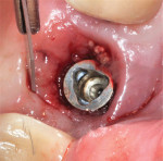 Fig 13. A circumferential incision with a #15C scalpel was used to remove the diseased fibrous tissue adjacent to the implant.