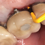 Fig 9. Case 2, 8 mm pocketing with BOP, mesio-palatal of upper right first molar.