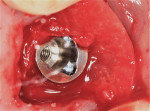 Fig 17. The collagen membrane was placed over the head of the implant and manipulated apically until it covered the graft. In this image the palatal edge of the membrane was
tucked into the space created between the soft tissue and crestal bone, and the buccal edge was still exposed.