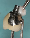 Fig 15. The underside of the restoration and the screw were cleaned and detoxified by burnishing with sodium hypochlorite, hydrogen peroxide, and sterile saline.